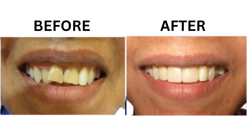 Your Smile Dental Makeover Options in Rayasandra
