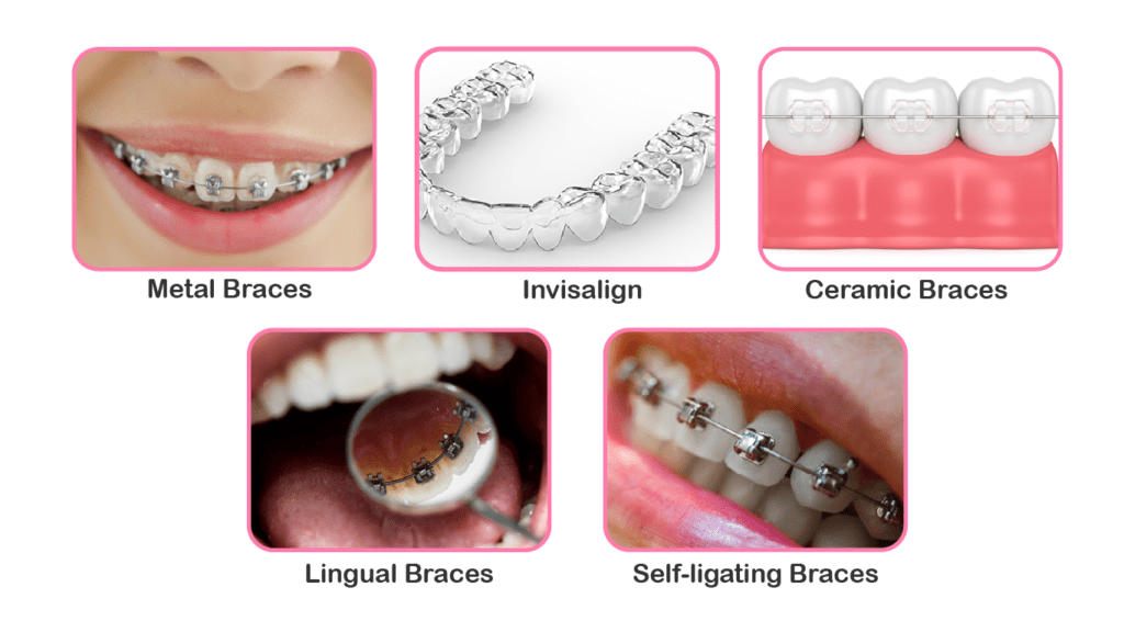 dental braces in kasavanahalli
