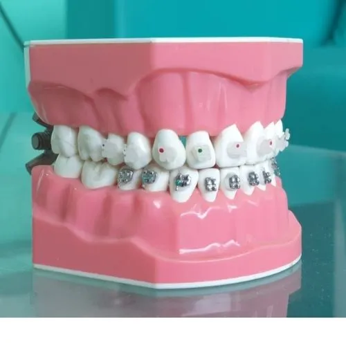 dental braces in kasavanahalli