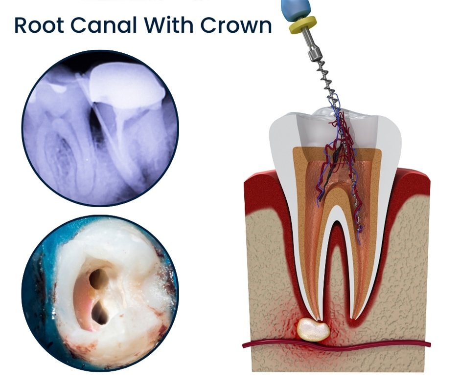 Root Canal treatment in slv layout