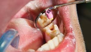 Root Canal treatment in slv layout