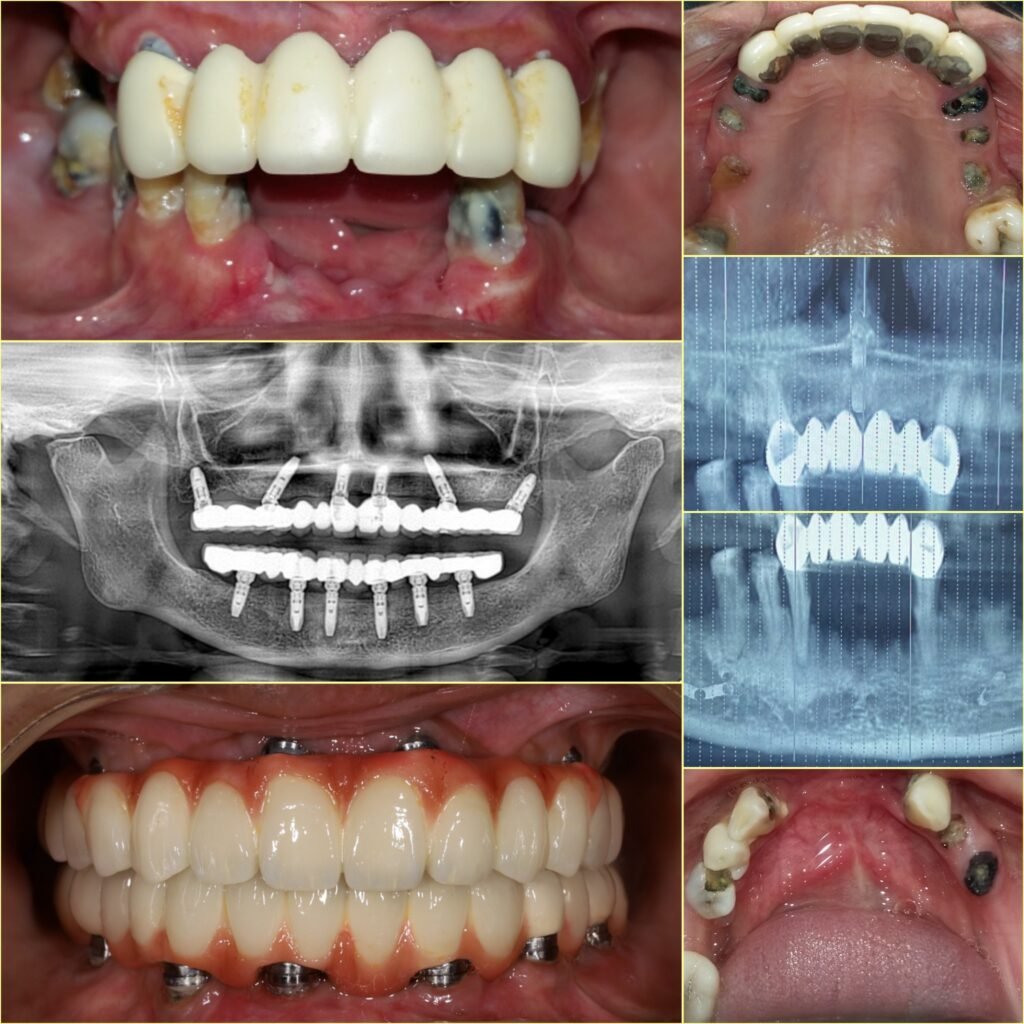 best dentist for dental implants in Rayasandra