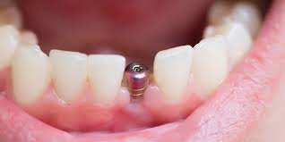 best dentist for dental implants in Rayasandra