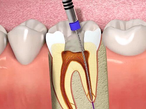 affordable root canal near Kasavanhalli Bangalore