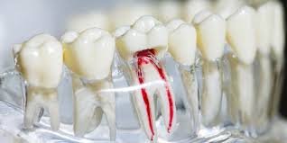affordable root canal near Kasavanhalli Bangalore