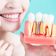 dental implants near Rayasandra Bangalore