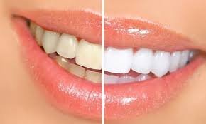 teeth whitening near Rayasandra Bangalore
