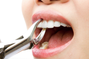 Tooth Extraction in Hsr layout