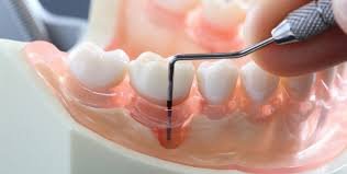 Painless tooth extraction with Piezosurgery in Bangalore