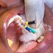 Root Canal treatment in slv layout