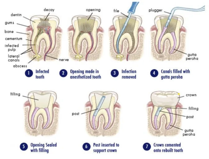 Root Canal treatment in slv layout