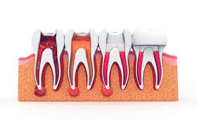 affordable root canal near Kasavanhalli Bangalore