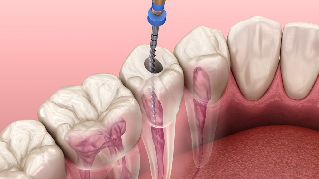 affordable root canal near Kasavanhalli Bangalore