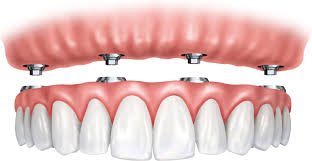 dental implants near Rayasandra Bangalore