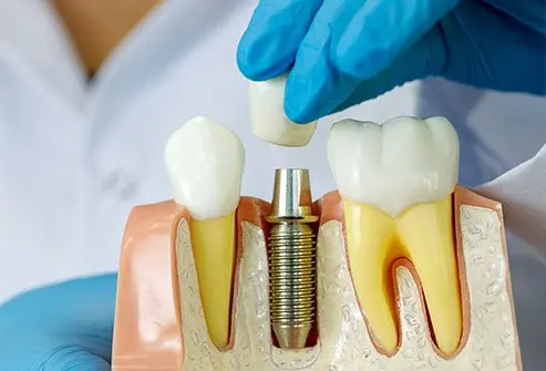 dental implants near Rayasandra Bangalore