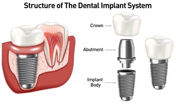 dental implants near Rayasandra Bangalore