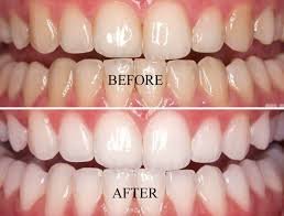 teeth whitening near Rayasandra Bangalore