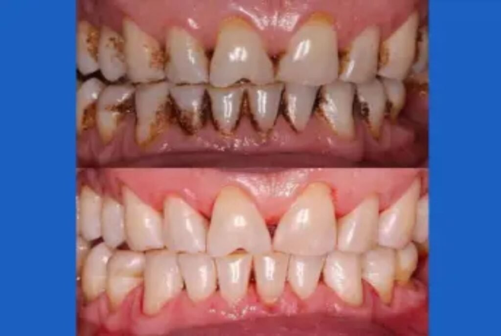 teeth whitening near Rayasandra Bangalore