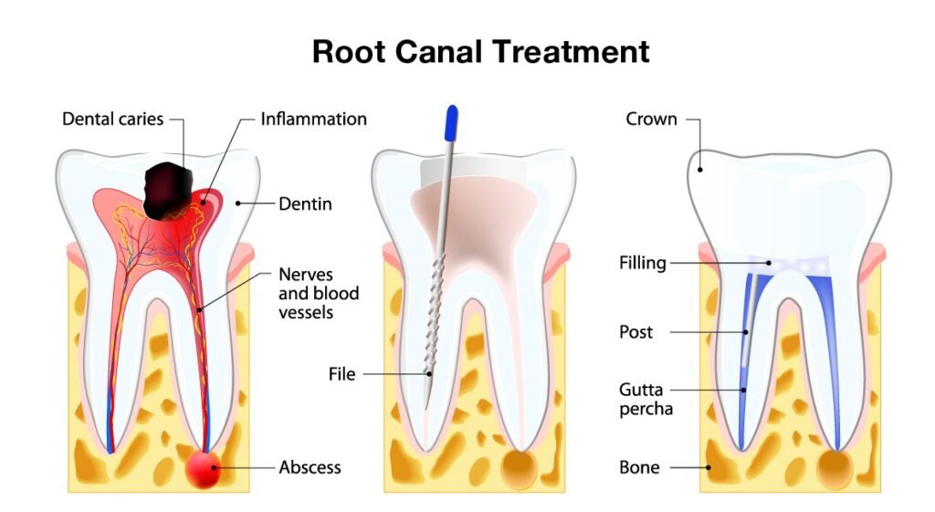 root canal specialist near Rayasandra